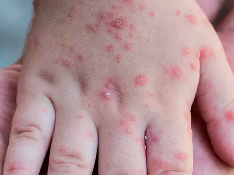 Confirman brote de virus coxsackie en San Martín Texmelucan, Puebla