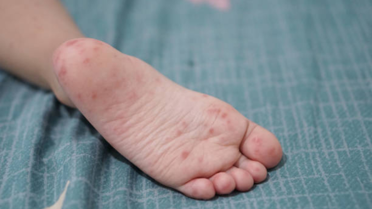 Reporta Salud 20 casos de coxsackie en Tabasco