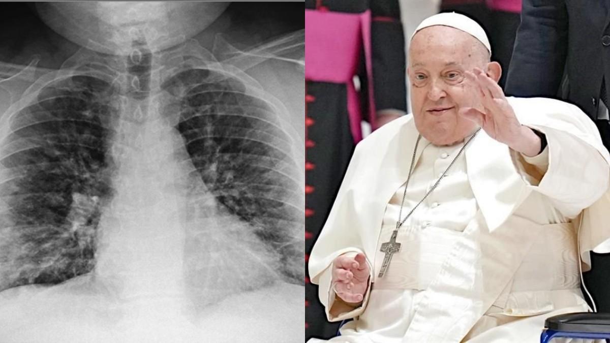 Los problemas de salud que tuvo el papa Francisco