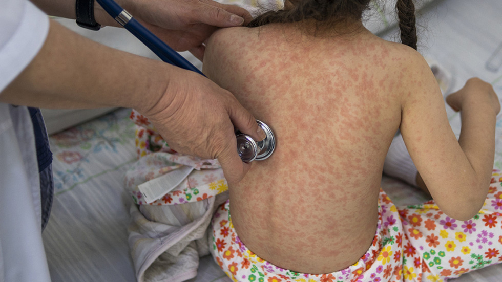 Aumentan a 126 los casos confirmados de sarampión en México