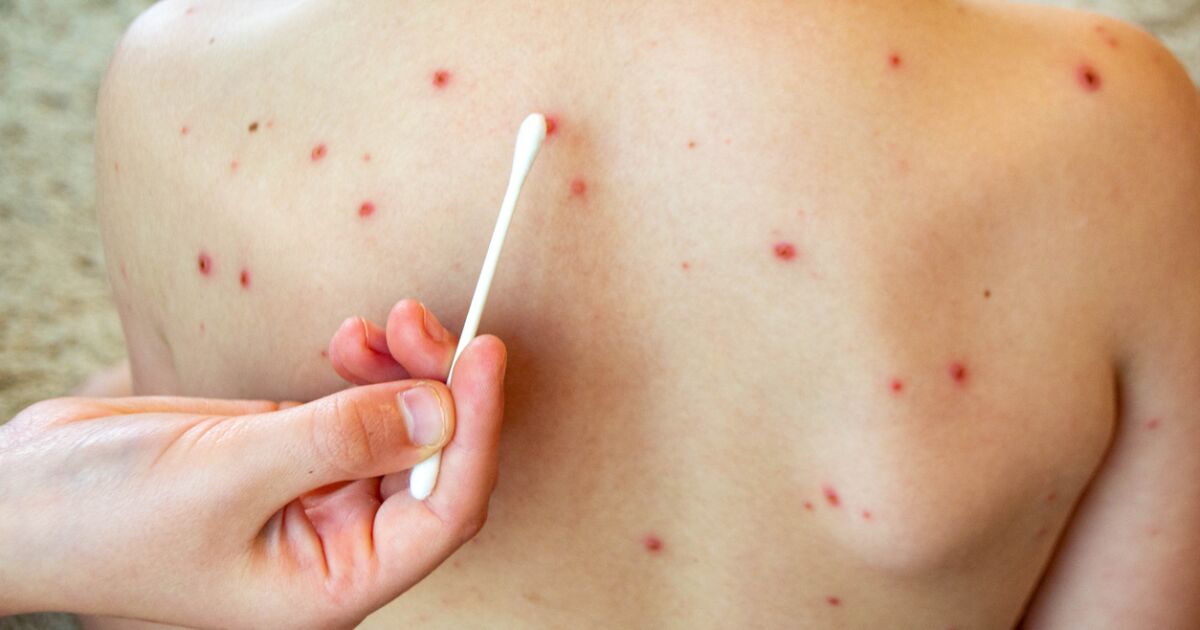 Aumentan a 421 los casos de sarampión en México