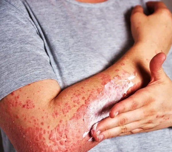 Llama Salud a la población a continuar vacunándose, tras registrarse el primer caso de Sarampión en Tabasco