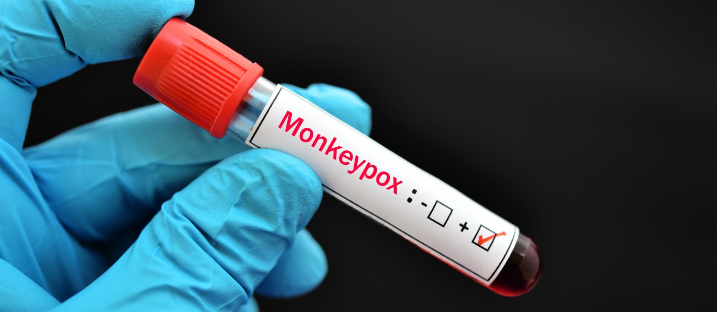 Se disparan casos de viruela del mono en México; suman 174