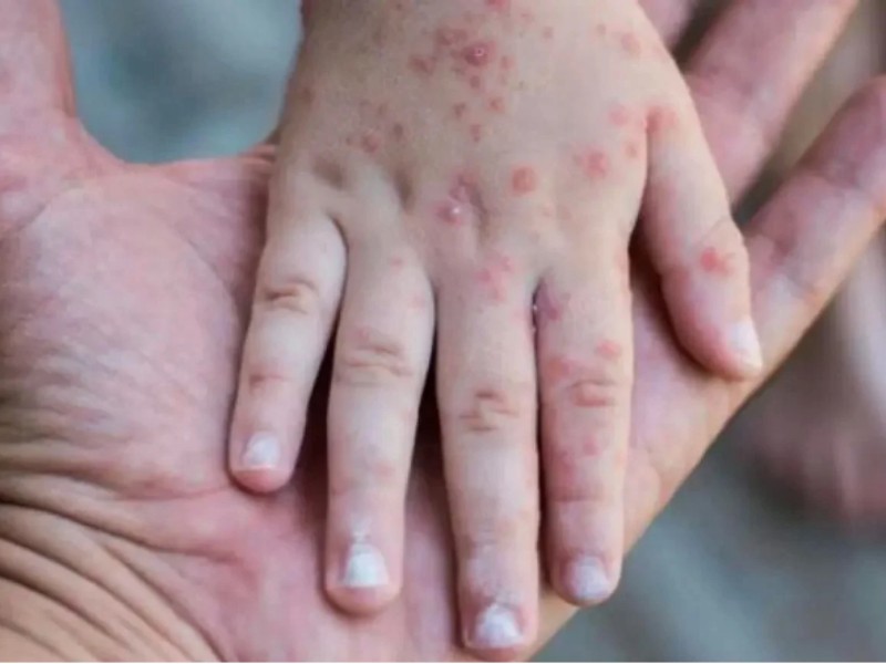 Suman 2 mil 400 casos de sarampión; México ocupa el segundo lugar en las Américas