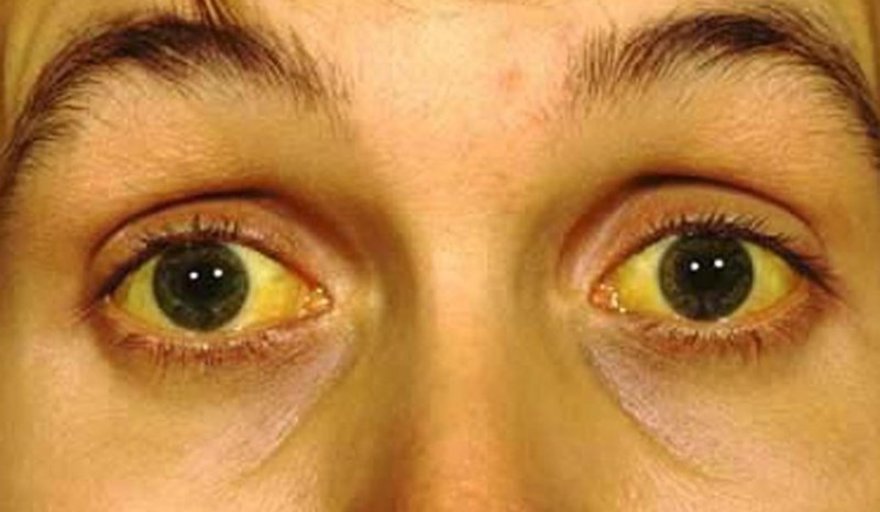 Día Mundial contra la Hepatitis: causa 1.3 millones de muertes al año